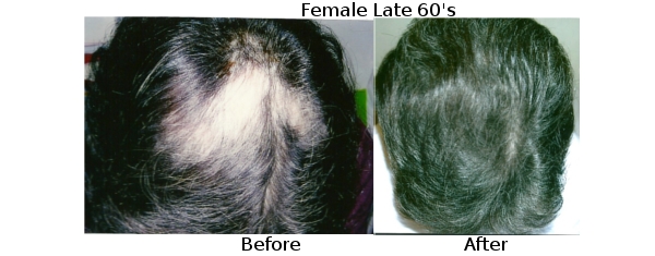 Hair Loss Success Stories - Natural Regrowth both Male and Female