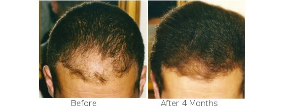 Natural Hair Loss Treatment for Men and Women.