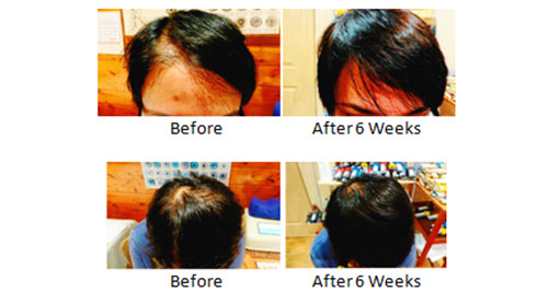 Female Hair Loss Treatment and Natural Hair Regrowth Female Hair Loss Treatment and Natural Hair Regrowth