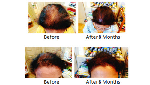Female Hair Loss Treatment and Natural Hair Regrowth