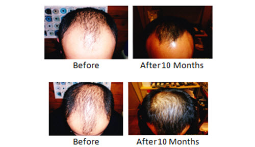 Male 28 years old Natural Hair Regrowth Treatment, before and after 10 months.